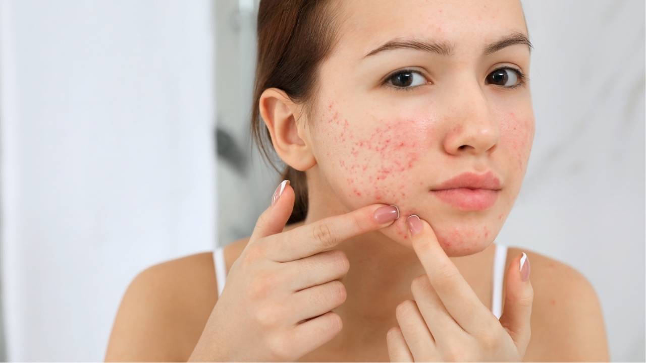 突然爆瘡怎麼急救處理？解析爆瘡原因及營養師推薦抗痘食物