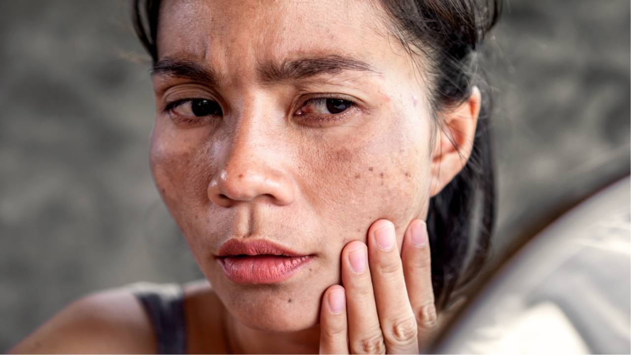 臉上雀斑能消除嗎？拆解雀斑成因及去雀斑推薦方法與食物清單